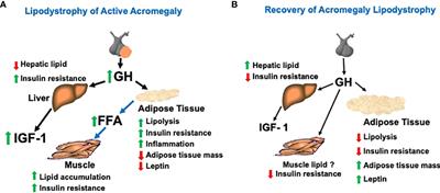 The acromegaly lipodystrophy